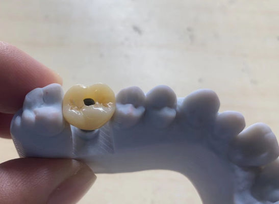 kupować Wysokiej precyzji implant podtrzymany koroną Stabilny i łatwy w konserwacji produkcja online