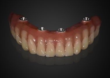 kupować Zastosowane korony implantów zębowych odporne na zużycie produkcja online