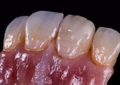 kupować Niemiecki Amanjilbach Zirconia Korona dentystyczna Wysoka gęstość z dostosowaniem produkcja online