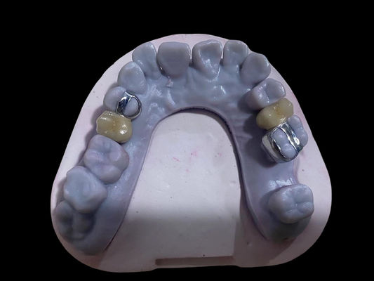 kupować Wysoce precyzyjne PFM Crown Dental Alloy Ni Free Metal Porcelanowe korony produkcja online
