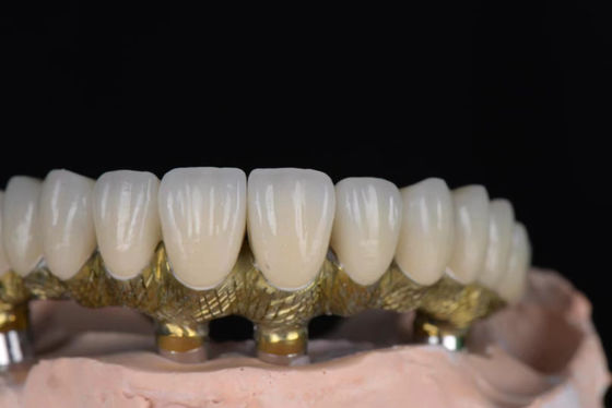 kupować Naturalnie wyglądająca koronowa porcelana stopiona w metalu wysokiej precyzji do implantów stomatologicznych produkcja online