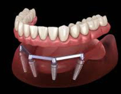 kupować Przetłuszczona sztabla do implantów zębów dla przezroczystości i naturalnej estetyki produkcja online