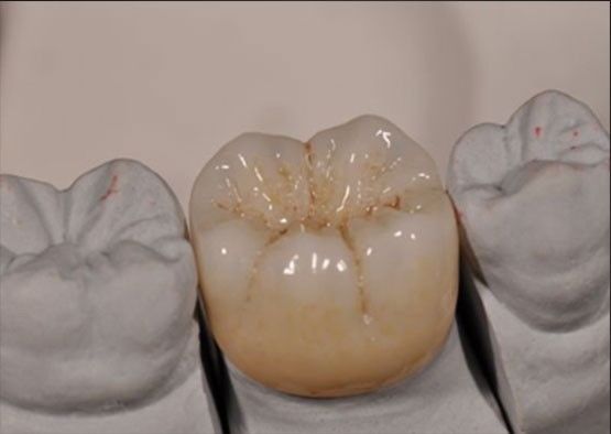 Wysoka estetyka Noritake Zirconia Naturalny kolor stabilny dla pełnej korony z cyrkonia