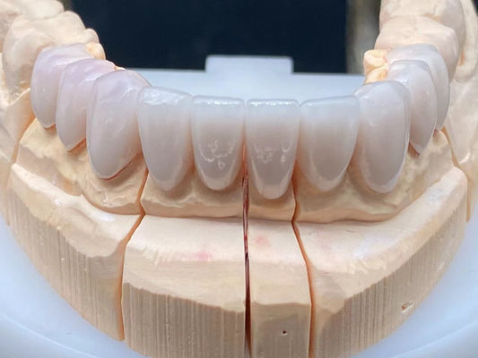 Laboratorium stomatologiczne E Max Ceramic Crown High Translucent z odpornością na korozję
