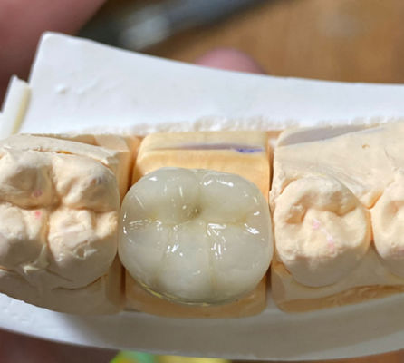 Precyzyjna estetyczna mocna zęba PFM porcelana stopiona do metalowej korony w stomatologii